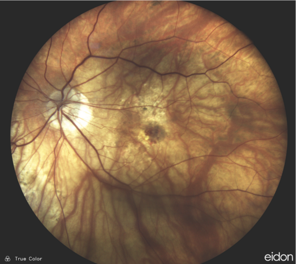 Myopic Maculopathy