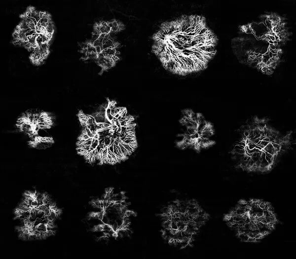 MNV Patterns Observed on OCTA with Toward Pi 
